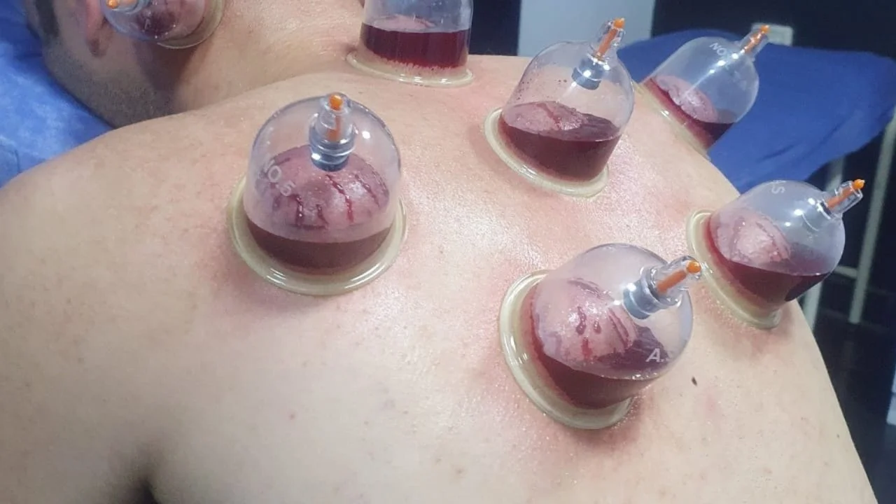 الحجامة-الرطبة